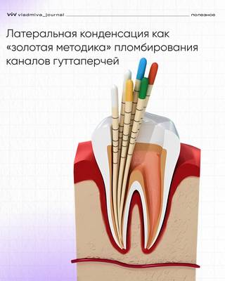 Латеральная конденсация: простой метод обтурации холодной гуттаперчей.